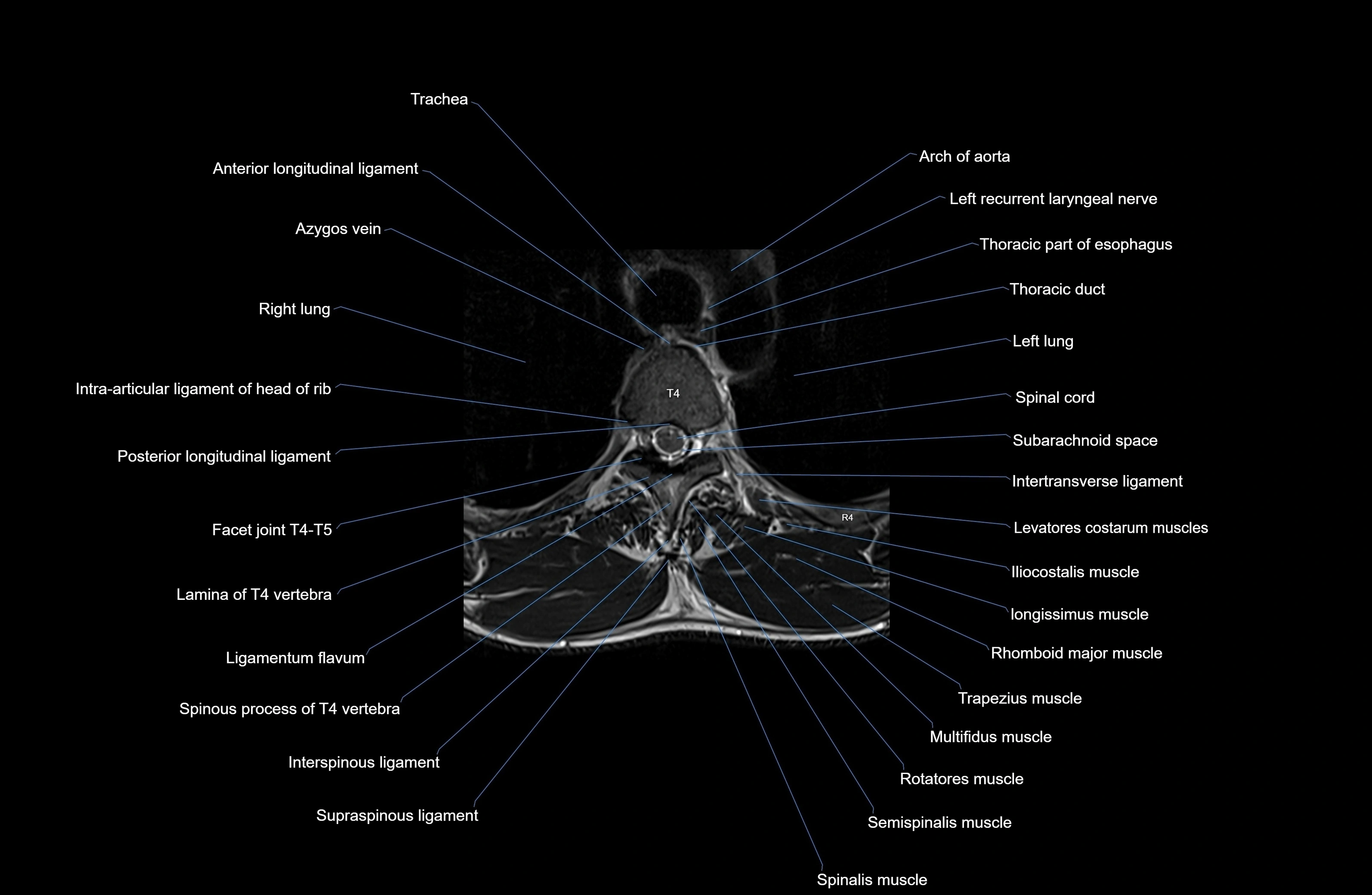 MRI thoracic spine axial  cross sectional anatomy 3T radiology  image-img-00001-00028.webp